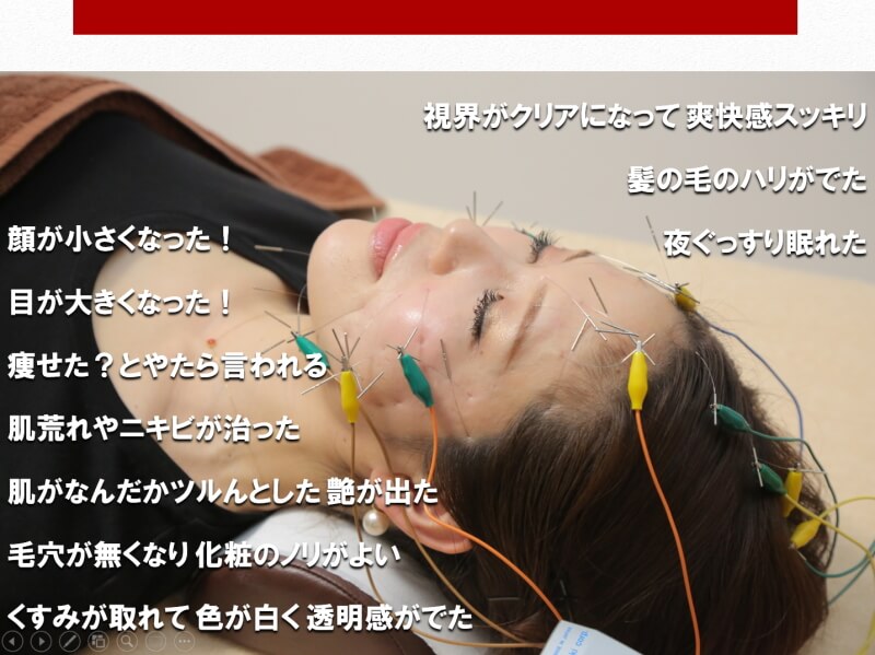 たるみの改善 名古屋で美容鍼なら長谷川亮 鍼灸院