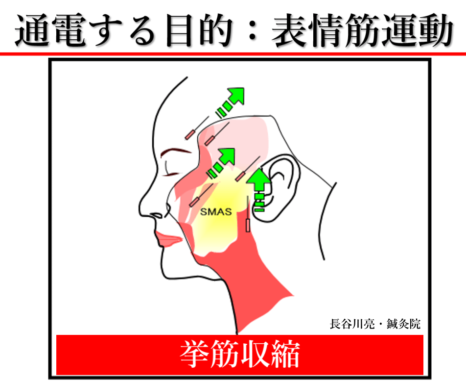 たるみの改善に美容鍼