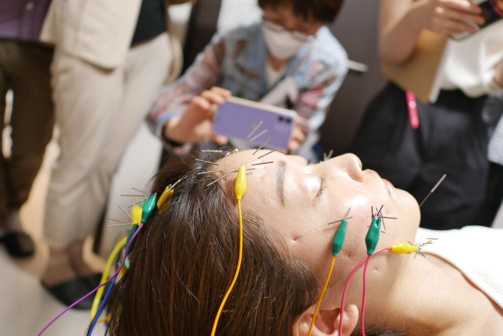 電気を流す美容鍼の実演
