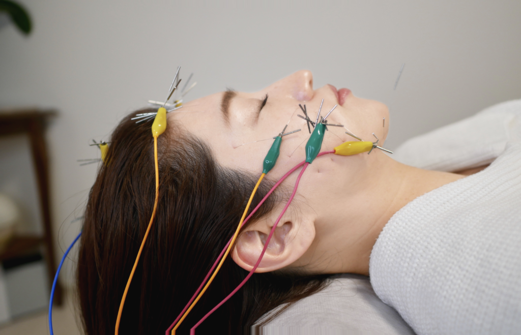 電気を流す美容鍼とは何か？